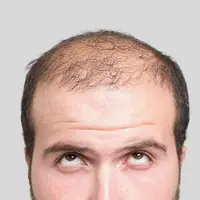 ریزش های مو قابل درمان هستند؟
