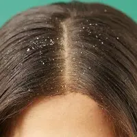 با این روش خانگی شپش موی سر را درمان کنید