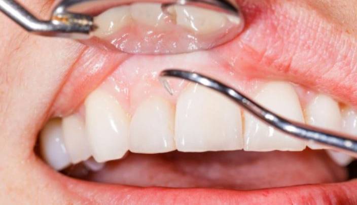 لثه کلید ابتلا به بسیاری از بیماری های خطرناک است