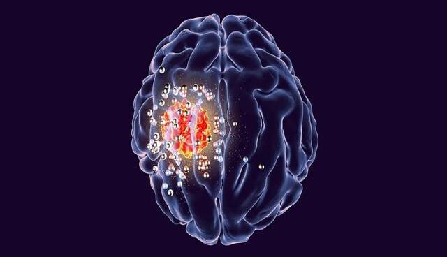ابداع ایمپلنت مغزی نابودکننده تومور سرطان مغز به همت دانشمند ایرانی