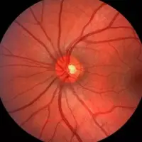حفاظت از عصب بینایی با کمک سلول‌های پیش‌ساز عصبی