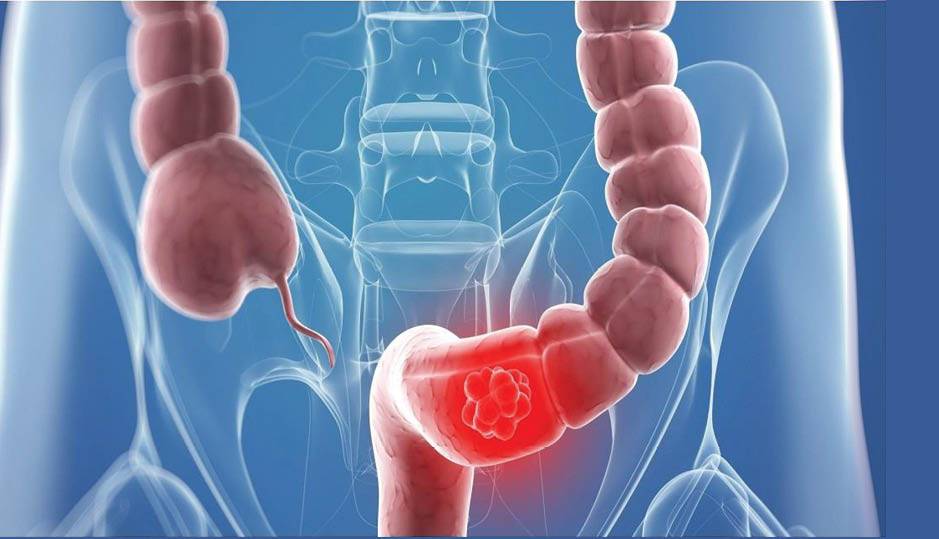 بهترین و بدترین ها برای سرطان روده