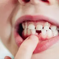 وضعیت پوسیدگی دندان در کودکان اوتیسم نامناسب است