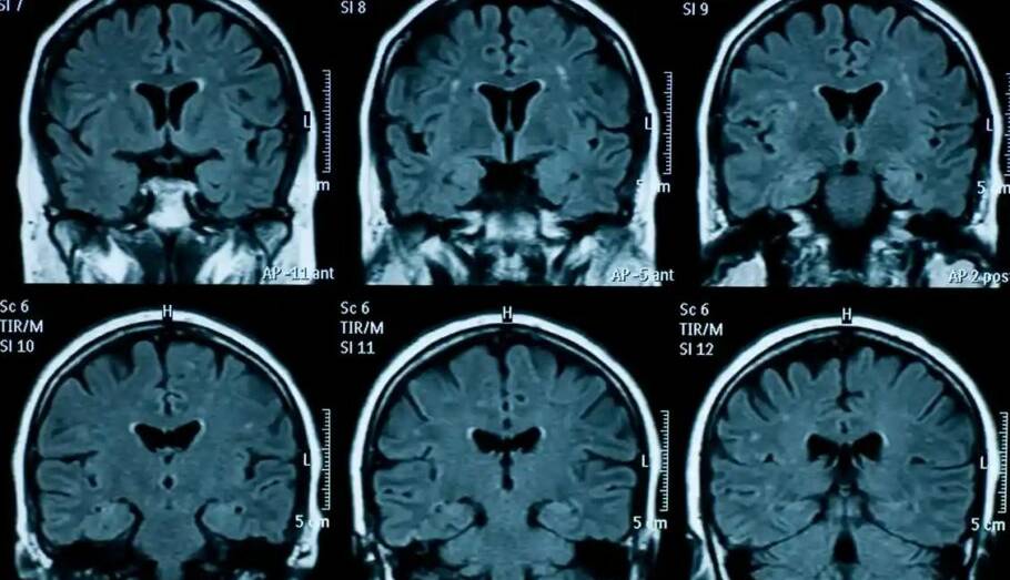 مغز نوجوانانی که در دوران قرنطینه کرونا زندگی کرده‌اند، سریع‌تر پیر می‌شود