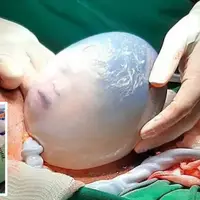 اتفاق نادر تولد یک نوزاد در حالی که کیسه آب هنوز کاملاً سالم است
