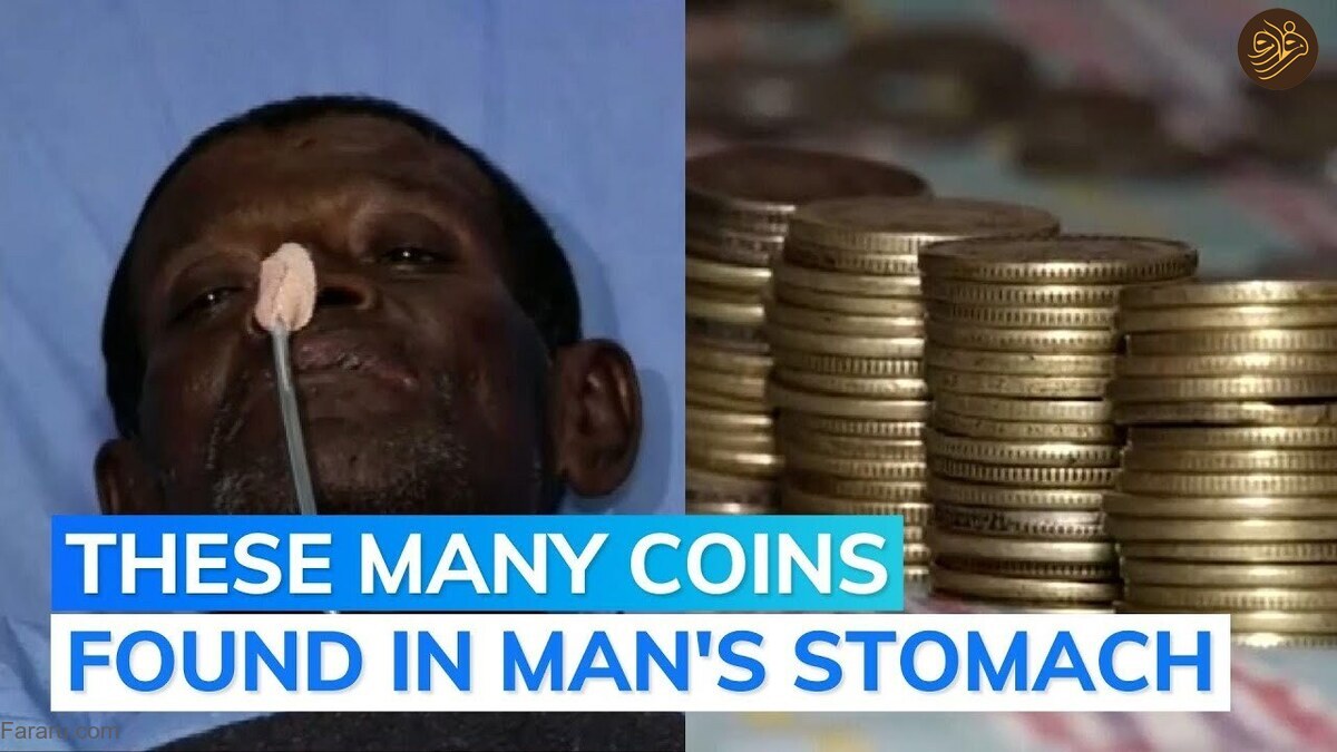 خارج کردن ۱۸۷ سکه از معده یک مرد!