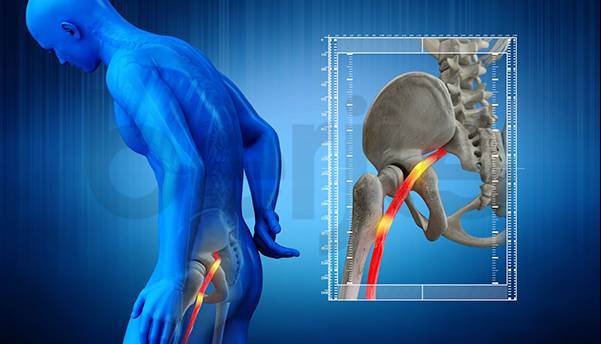 سیاتیک چیست و چه علائمی دارد؟