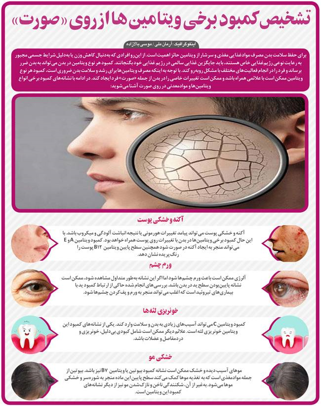 اینفوگرافی/ تشخیص کمبود برخی ویتامین ها از روی صورت