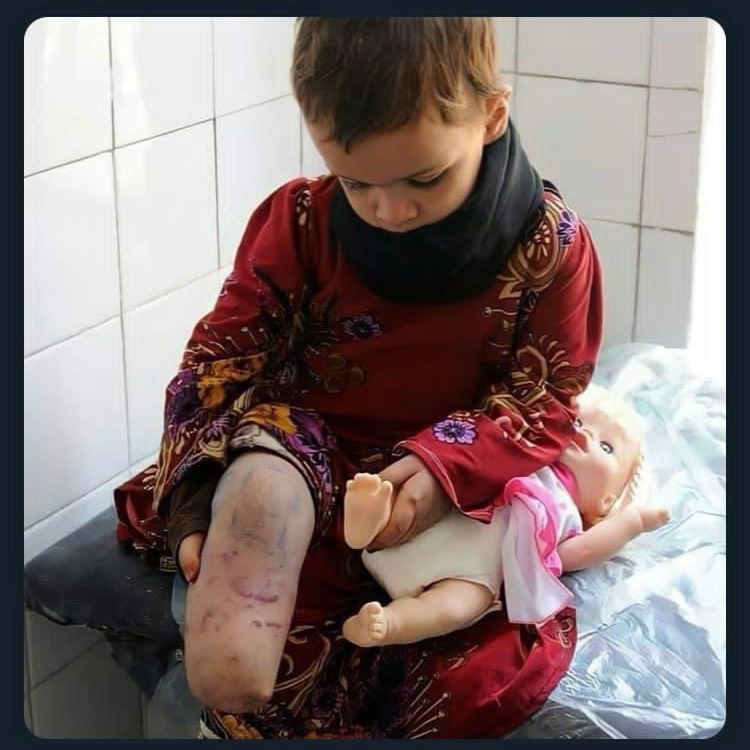 عکس/ تصویری دردناک از دختر یمنی
