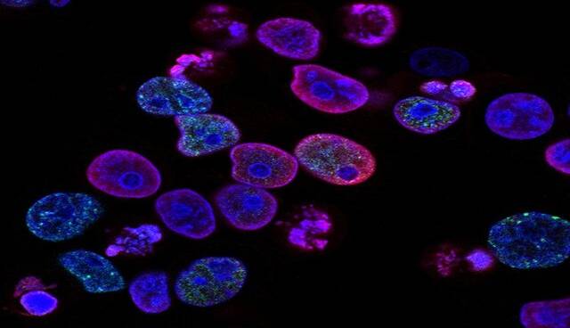 دانشمندان راهی برای تشخیص راحت‌تر سرطان روده بزرگ پیدا کردند