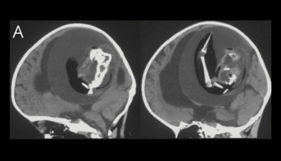 پدیده‌ای فوق‌العاده نادر؛ یک جنین را در مغز کودکی یک‌ساله پیدا شد!