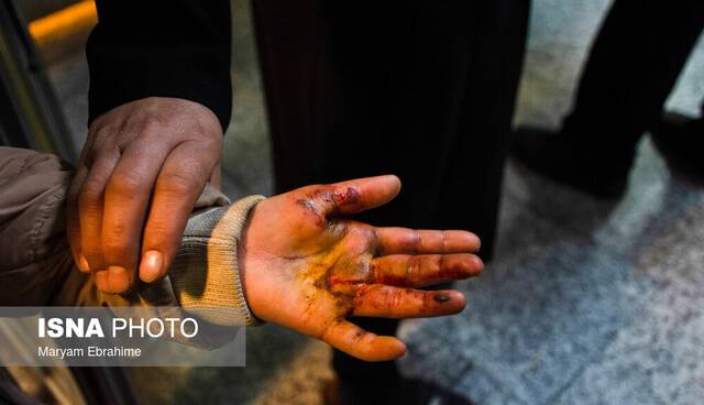 اقدامات اورژانسی در مواجهه با فردی که دچار سوختگی شده است