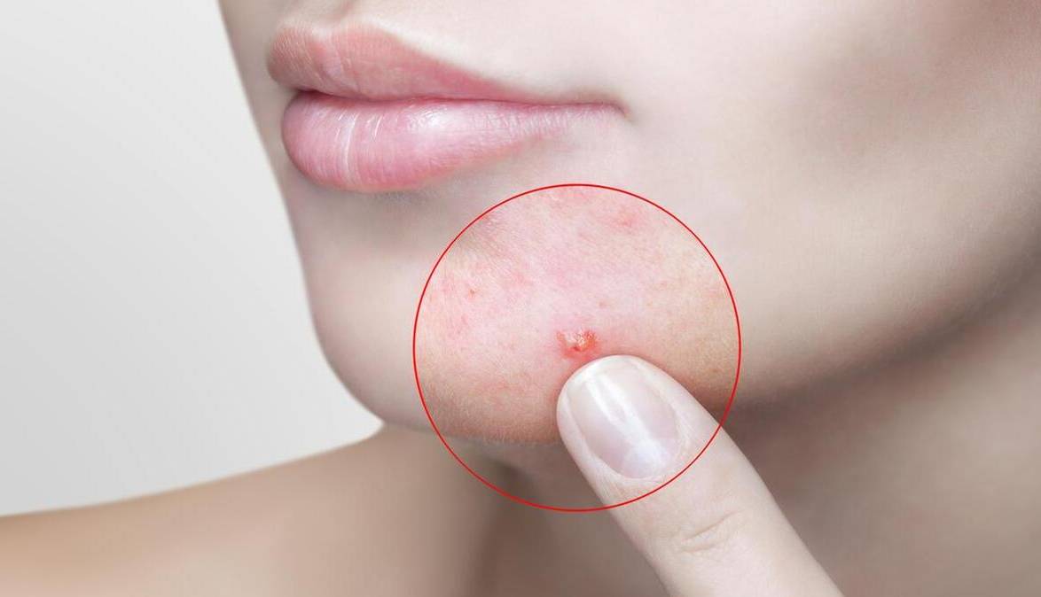 چرخه قاعدگی چه تاثیری بر پوست می‌گذارد؟