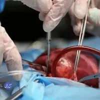 اهدای اعضای کودک دو و نیم ساله بندرعباسی به سه کودک جان دوباره بخشید