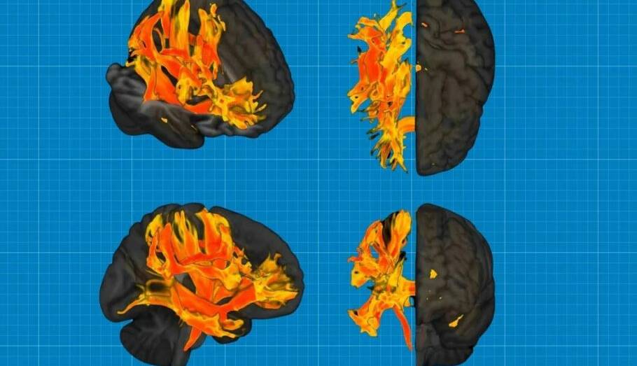 محققان برای اولین‌بار اثر فشار خون بالا بر مغز و رابطه آن با زوال عقل را کشف کردند