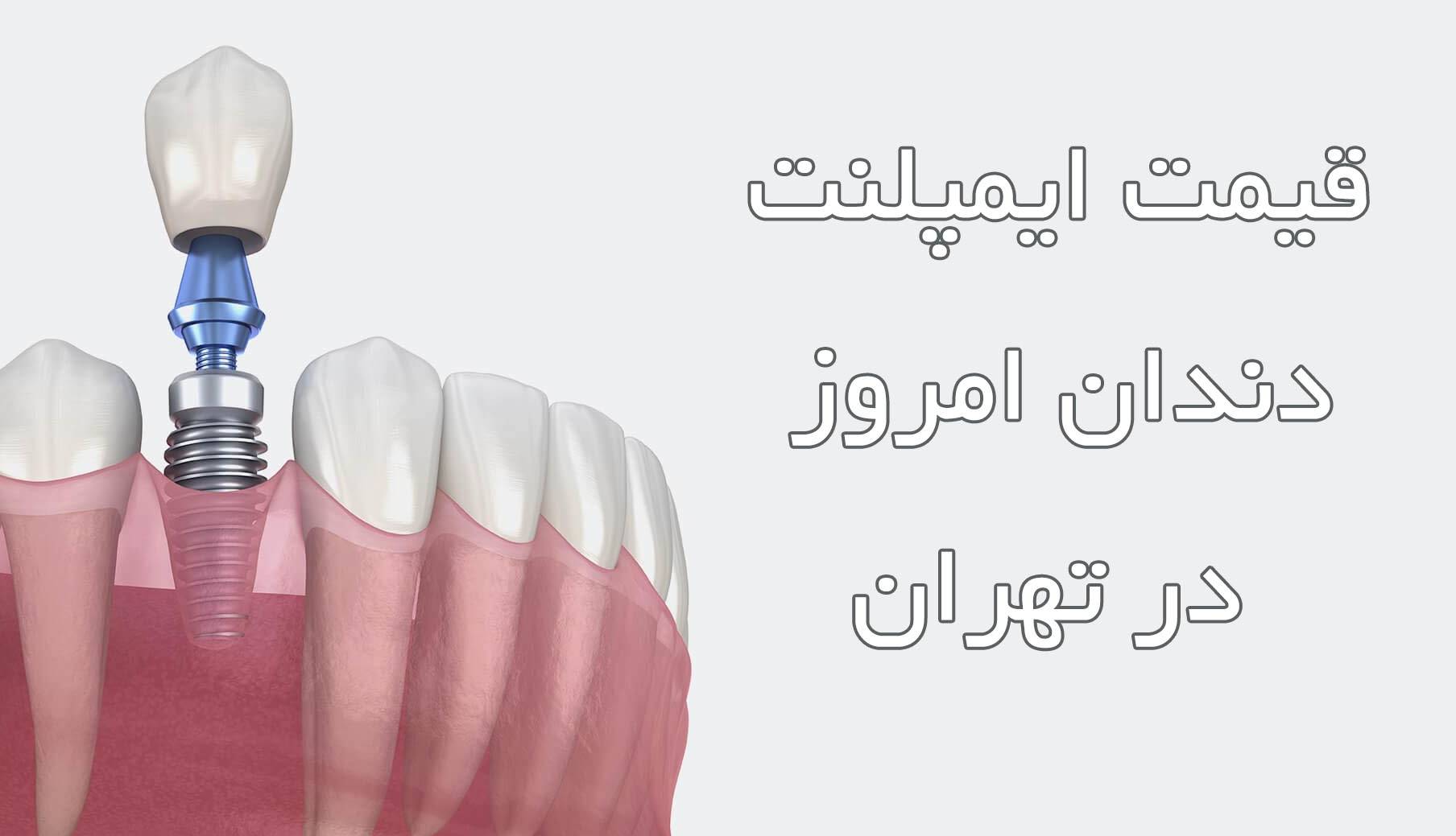 قیمت ایمپلنت دندان امروز در تهران
