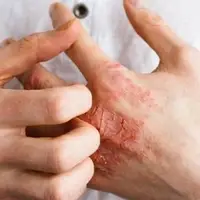 دانشمندان درمان بیماری نادر ژنتیکی پوست را پیدا کردند