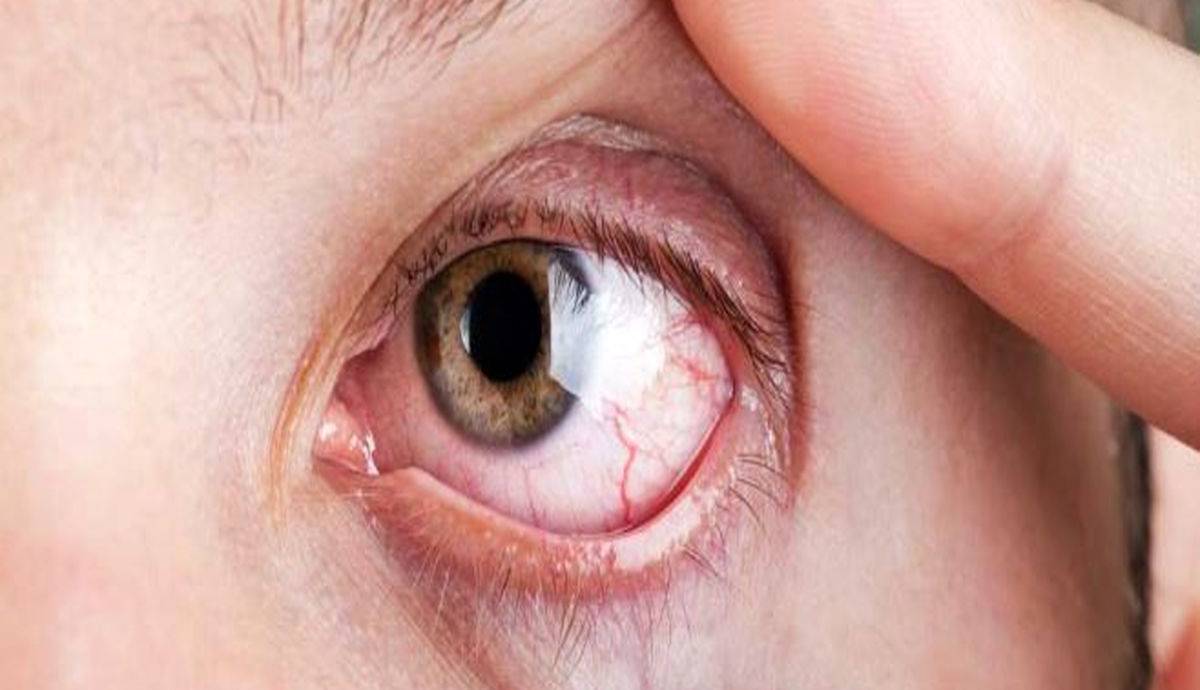 شیوع عجیب یک بیماری چشمی بعد از ۵۵ سالگی در سیگاری ها