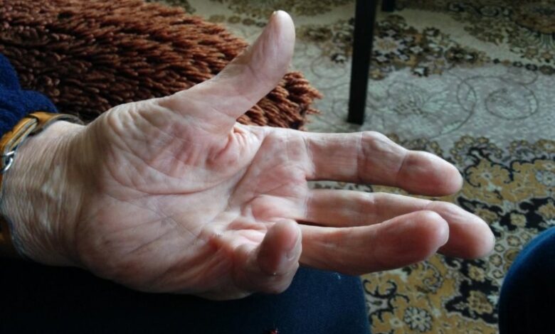 ژن نئاندرتال ها عامل کج شدن انگشتان در دوران پیری می شود