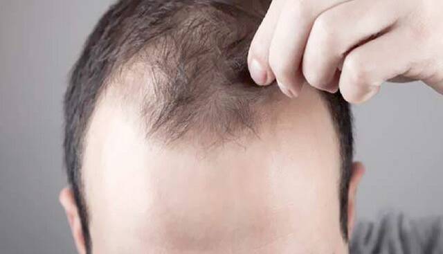 سلول‌های پیر راه‌گشای درمان طاسی می‌شوند