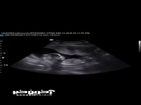 ویدئو جالب از سکسکه جنین در شکم مادر
