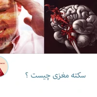 سکته مغزی چیست؟