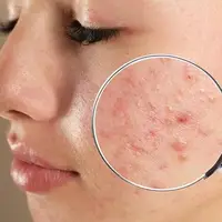 یک مولکول جدید درمان جوش صورت را متحول می‌کند