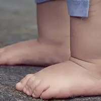 علت صافی کف پا در کودکان