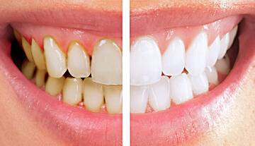 5 اشتباه رایجی که باعث زردی دندان‌ها می‌شود