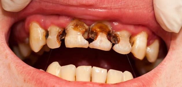 دندان چگونه خراب میشود؟