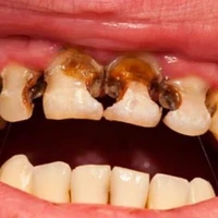 دندان چگونه خراب میشود؟
