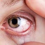 درمان خشکی چشم و تشنج در طب سنتی