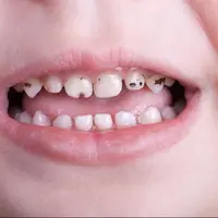 بهترین روش برای رفع ترس کودکان از دندانپزشکی