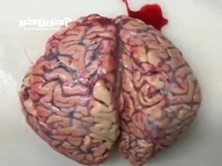 خونریزی مغزی چه طور اتفاق می افتد؟