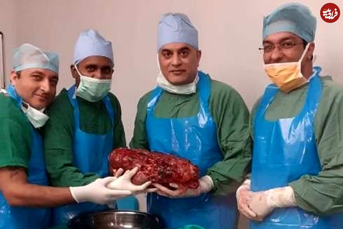 4 گوشه دنیا/ خارج کردن یک کلیه ۷.۴ کیلوگرمی از بدن یک بیمار