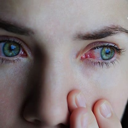 نکاتی مهم درباره عفونت چشم