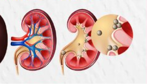 اینفوگرافی/ ۸ عادت غلط که سبب بروز سنگ کلیه می‌شود