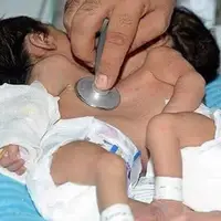 موفقیت اولیه در جراحی دوقلوهای به هم‌چسبیده‌ در شیراز/ کبد نوزادان‌ جدا شد