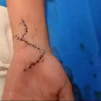 جراحی موفق ترمیم عصب دست پسر ۹ ساله در دلیجان