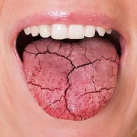 چه بیماری‌هایی باعث خشکی دهان می‌شوند؟