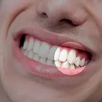 تأثیر مواد ترش بر مینای دندان‌