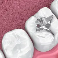 نانو شیاربند دندان برای جلوگیری از پوسیدگی دندان کودکان وارد بازار شد