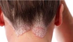 راه درمان قارچ پوستی