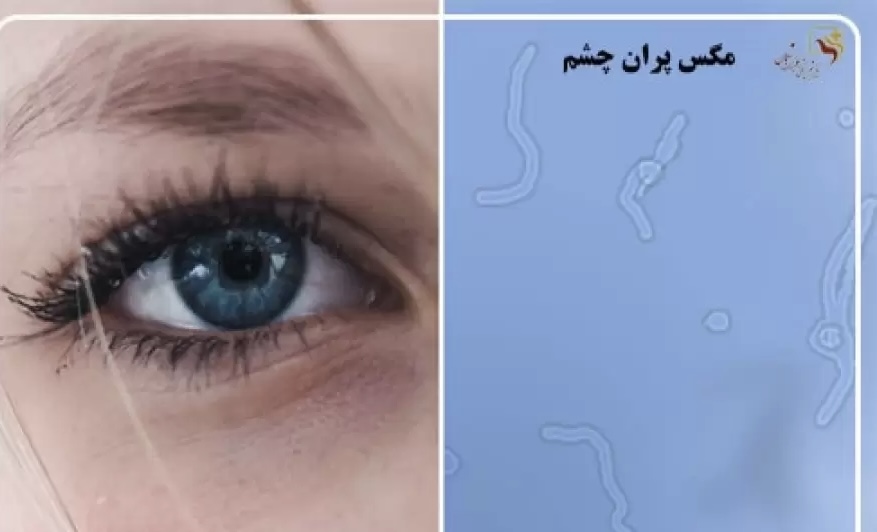 آیا باید نگران عارضه مگس‌پران در چشم‌مان باشیم؟