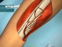انیمیشن جالبی از نحوه جراحی شکستگی استخوان ساق پا 