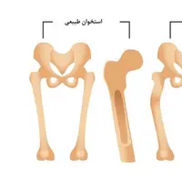 بیماری نرمی مفاصل درمان قطعی دارد؟ 