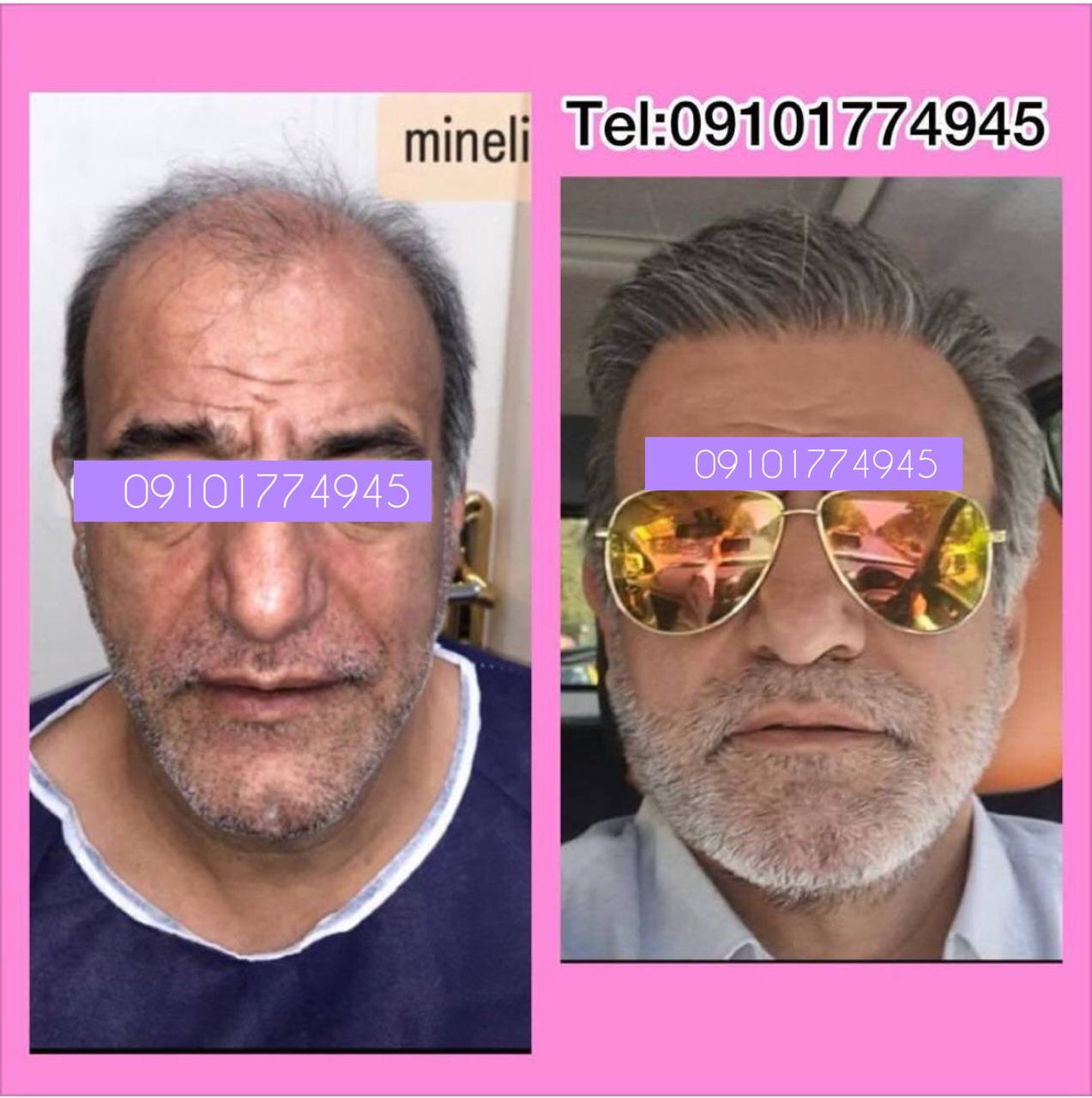 شروع یک انقلاب در درمان طاسی سر