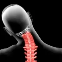 بیماری دنده گردنی چیست؟