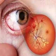 مراحل اثر دیابت بر روی شبکیه چشم