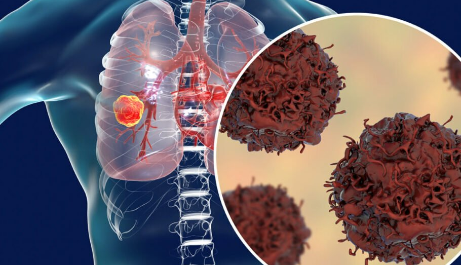 محققان یک قدم به درمان mRNA استنشاقی برای سرطان ریه نزدیک‌تر شدند
